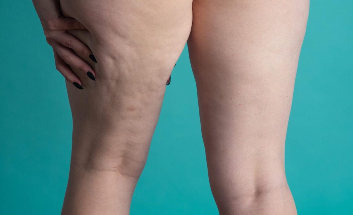 lipedema