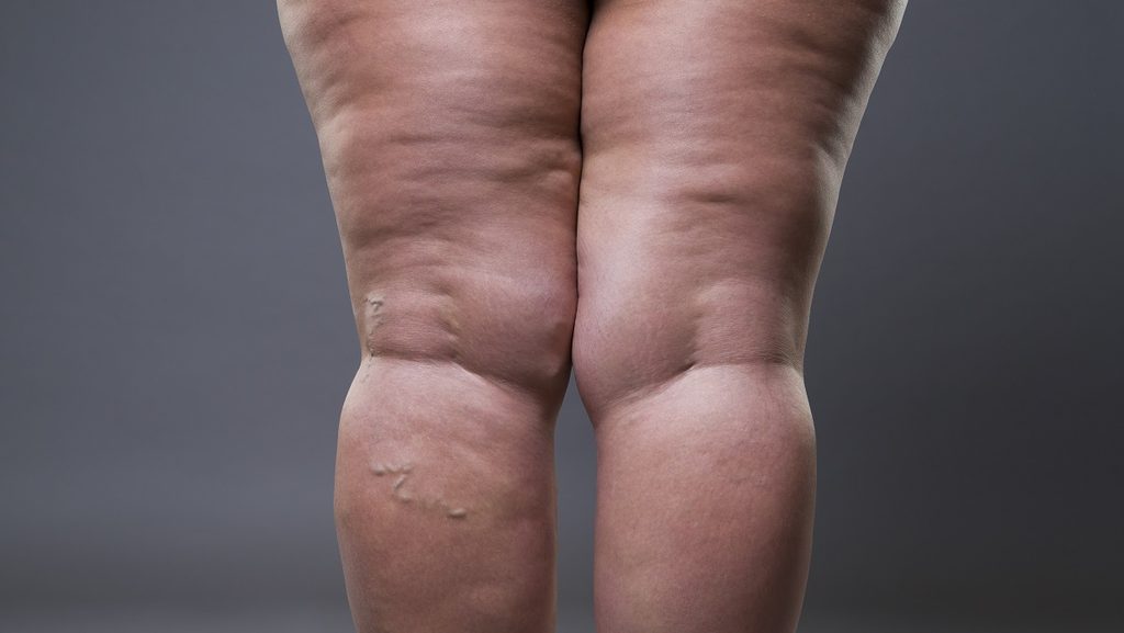 Pernas volumosas após emagrecer podem indicar lipedema 3 Depositphotos 161351294 XL Copia