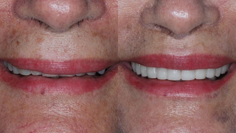 Liplift 1