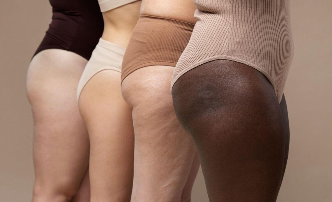 Pernas volumosas após emagrecer podem indicar lipedema 1 WhatsApp Image 2026 09 24 at 11.12.24
