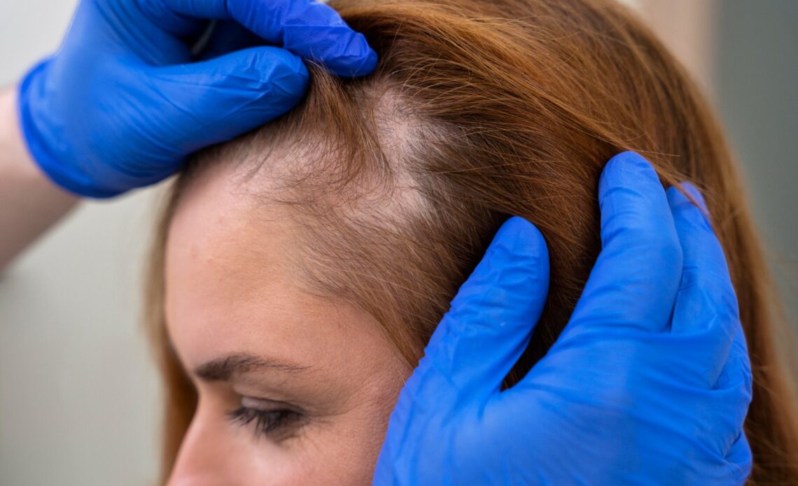 Cabelo afinando aos poucos pode ser sinal de alopecia androgenética 1 WhatsApp Image 2026 10 20 at 11.04.47