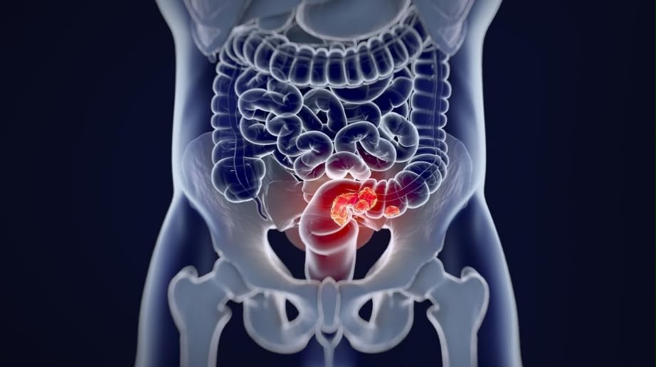 Câncer de intestino: diagnóstico de Lua Blanco reforça alerta para doença 4 WhatsApp Image 2026 10 21 at 11.53.52